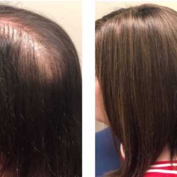 Hair loss before and after treatment.