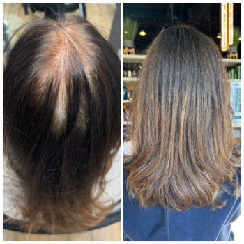 Hair thinning before and after treatment.